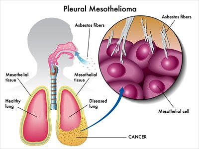 mesothelioma, cancer, diagnosis, asbestos exposure, asbestos, asbestos companies, cancer victims, mesothelioma patients, mesothelioma attorney, mesothelioma lawyer